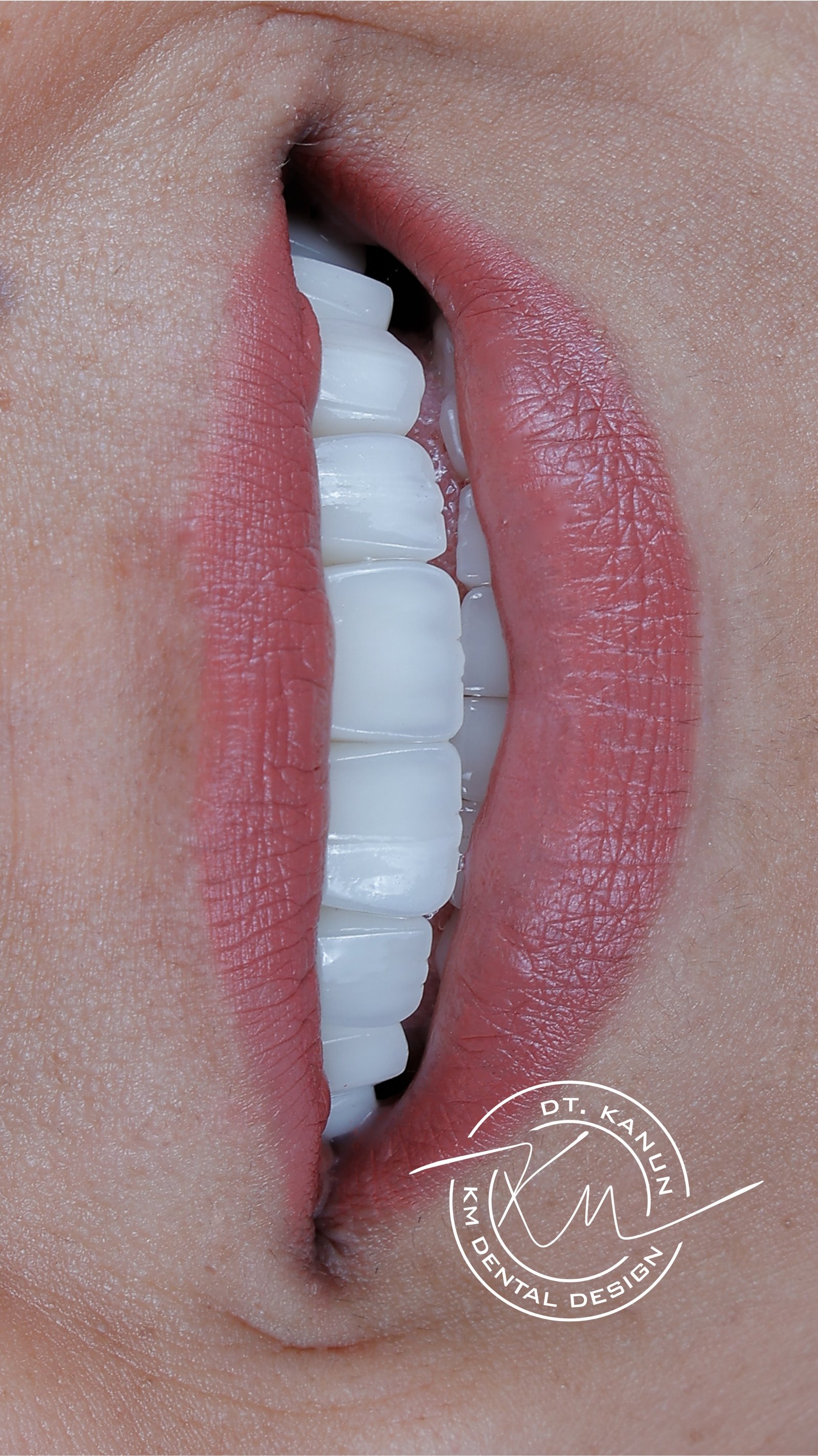 KM Dental Design - Before After 6